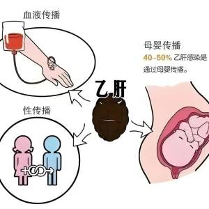 消除肝炎，積極行動！早期診斷和治療十分重要性！