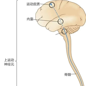 脑卒中的机制、高肌张力的病理生理学、临床表现、诊断与评估、治疗方法以及康复管理等问题